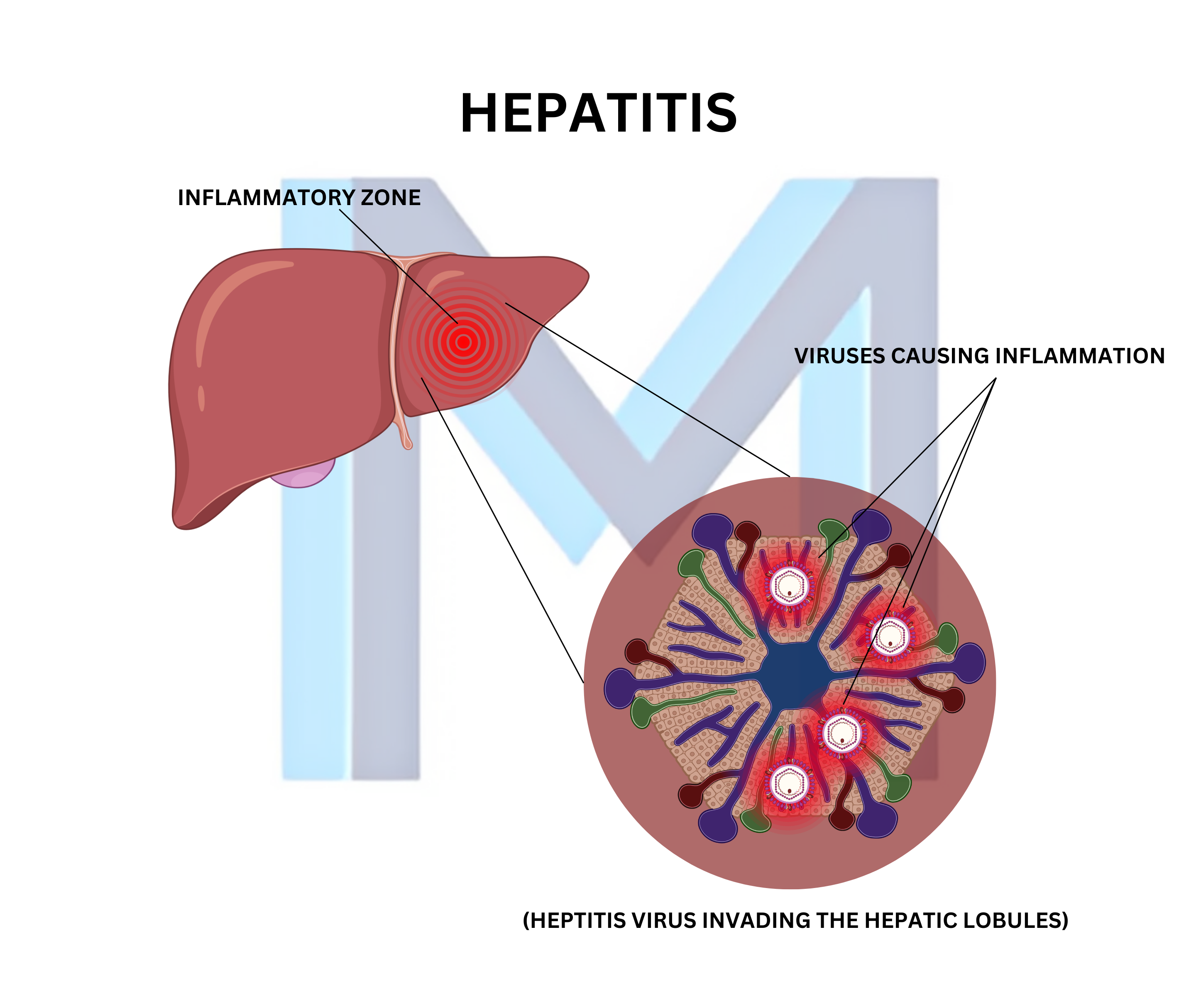 Viral Hepatitis